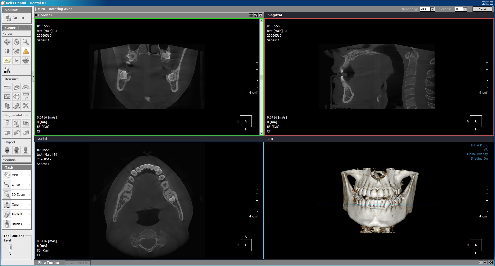 Tomografía CBCT 3D