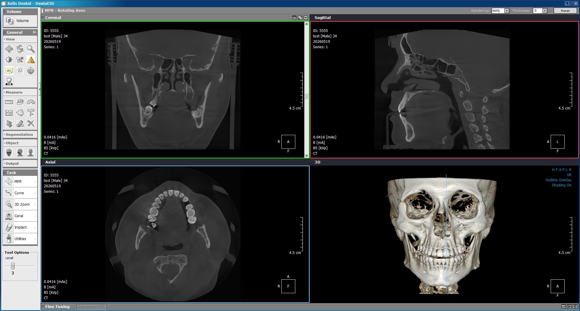 Tomografía CBCT 3D