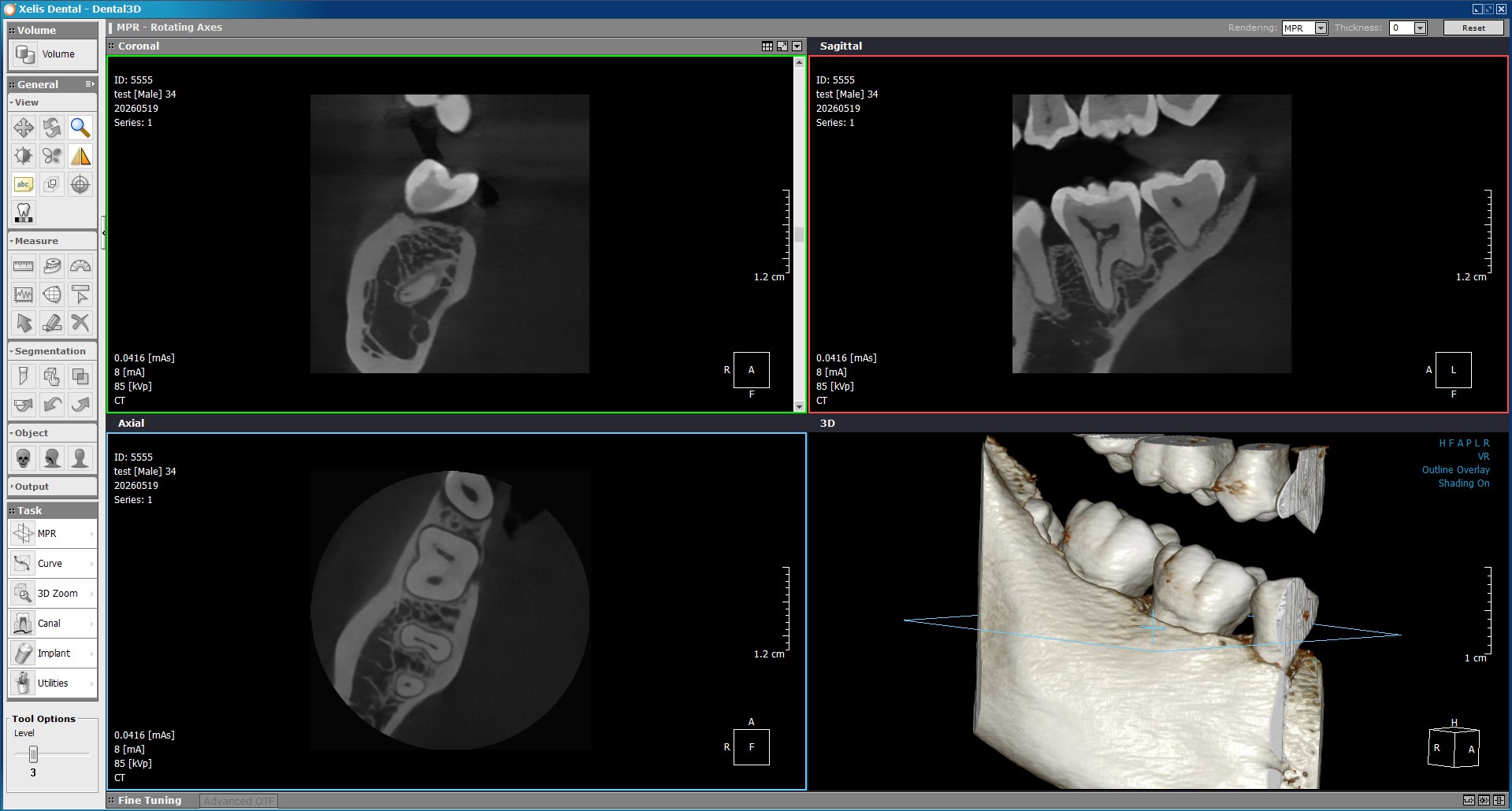 Tomografía CBCT 4x4